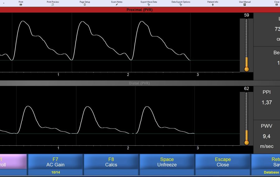 PWV measurement adult